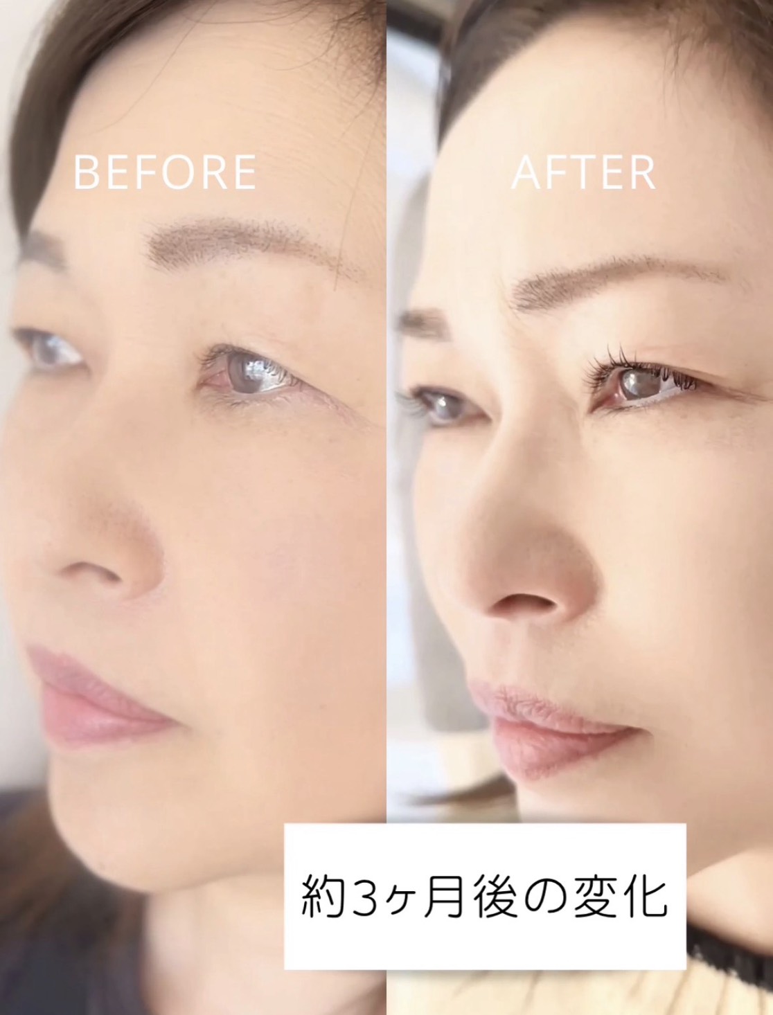 大阪堺市・北野田のeye me lash (アイミーラッシュ)による40代のまつげパーマとまつ育。